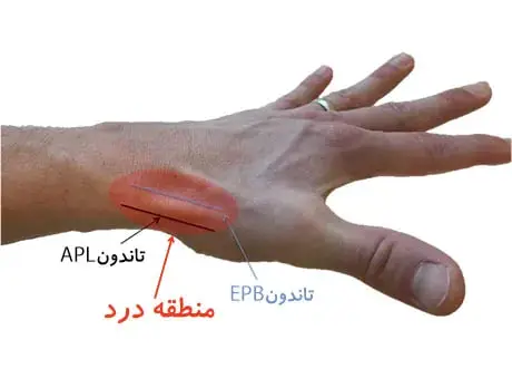 تاندونیت و تنوسینوویت