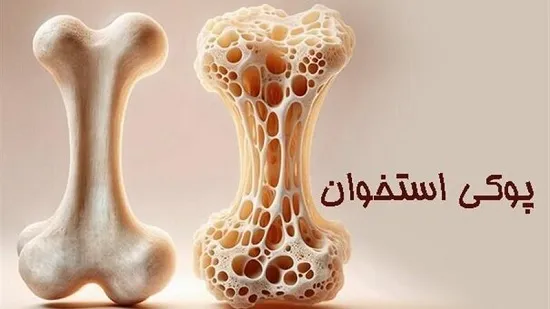 چه کسانی دچار پوکی استخوان می شوند؟