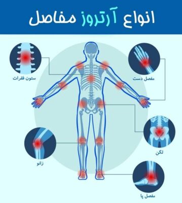 درمان آرتروز چیست؟