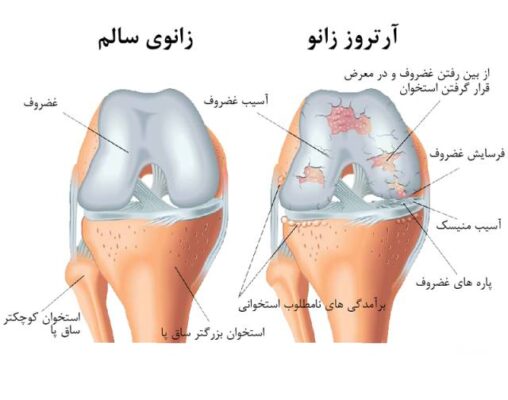 درمان آرتروز