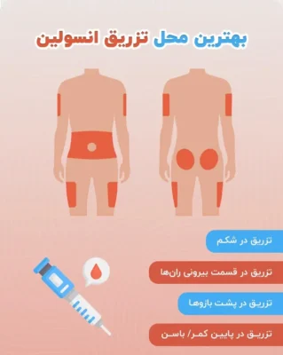 بهترین محل تزریق انسولین