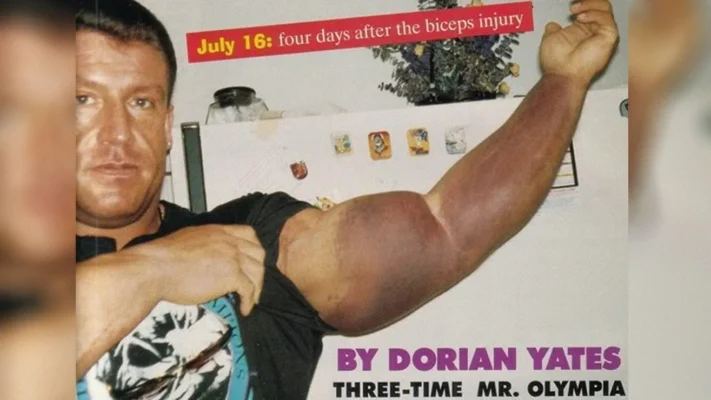 آسیب دیدگی های ورزشی (پاره شدن عضله دوسر بازو)